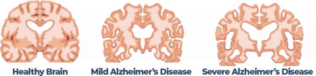 Is Sleep Linked to Alzheimer's? 3 Progression Of Alzheimers Disease